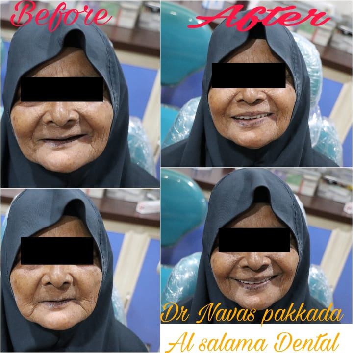 Complete Denture